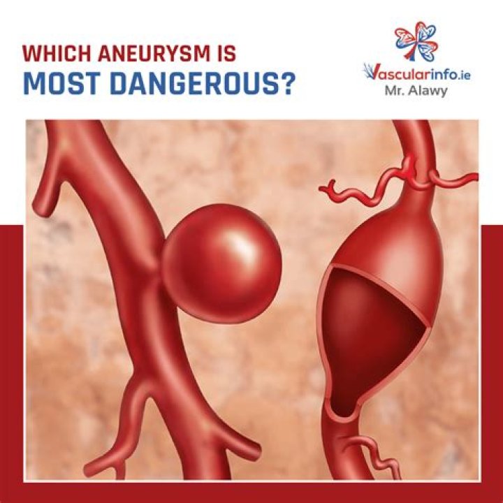 Are fusiform aneurysms dangerous?