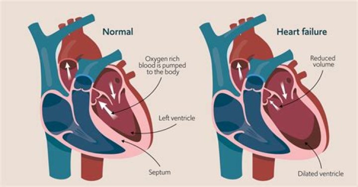 Is JVP raised in left heart failure?