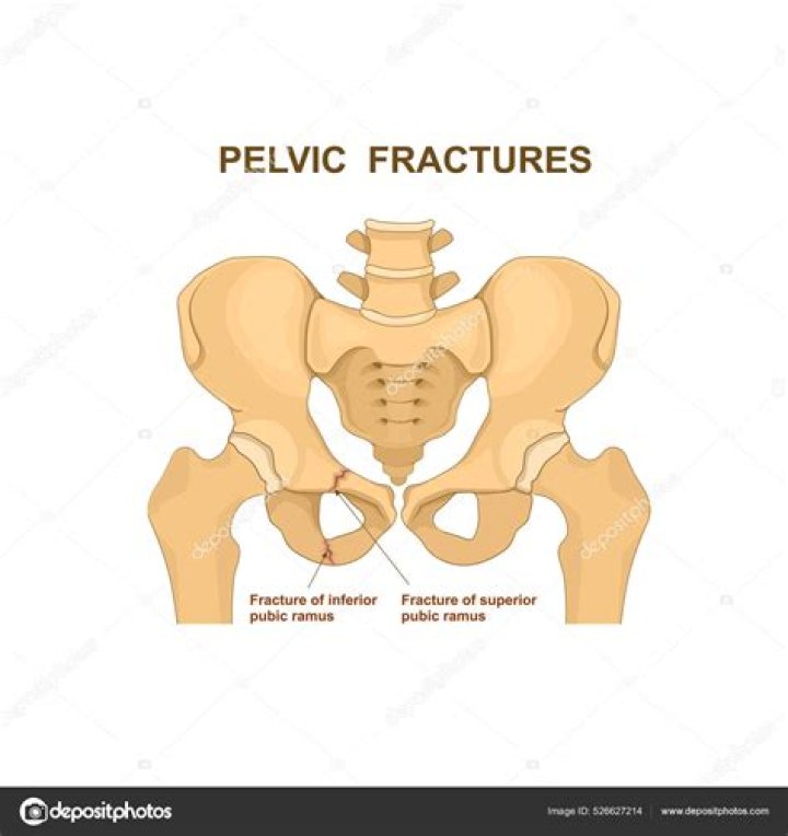 What is Ramus fracture?